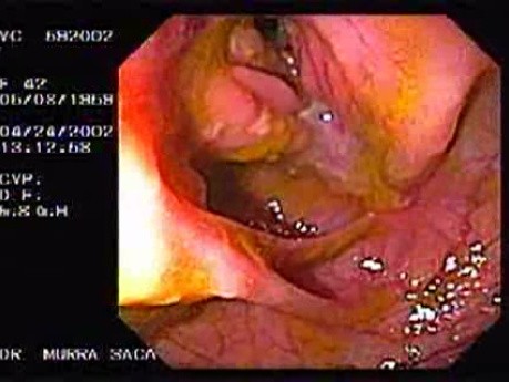 Crohn´s Disease (3 of 28)