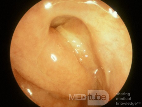 Eustachian Tube Orifice [swallowing]