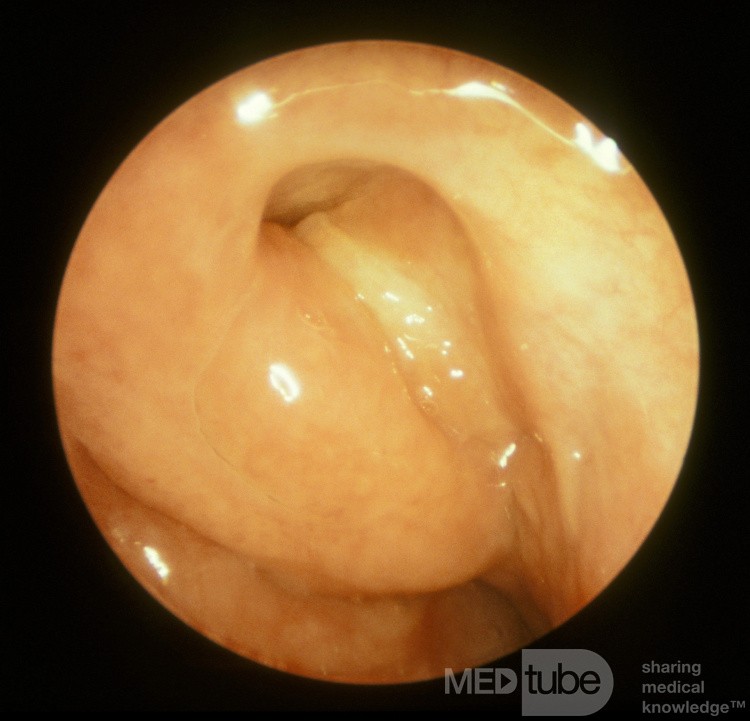 Eustachian Tube Orifice [swallowing]