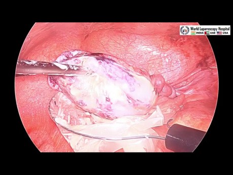 Laparoscopic Resection of a Torted Ovarian Dermoid Cyst