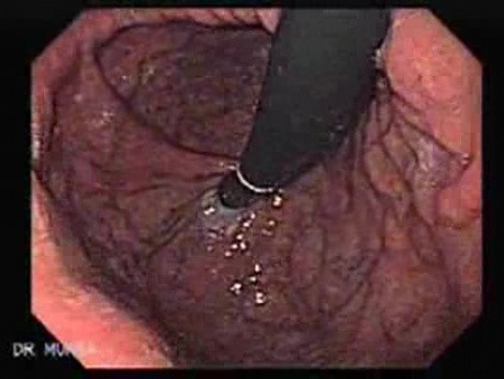 Esophageal Varices and Hiatus Hernia - 93 Year Old Male