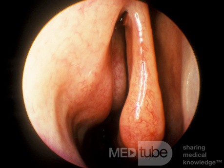 Enlarged Ethmoidal Bulla
