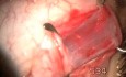Removal And Tie Low An Extraocular Muscle