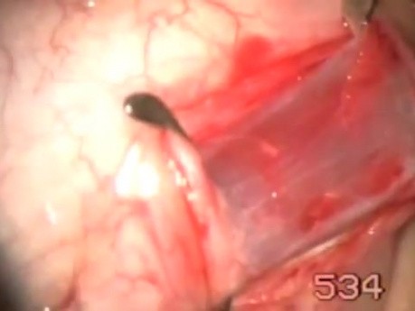 Removal And Tie Low An Extraocular Muscle