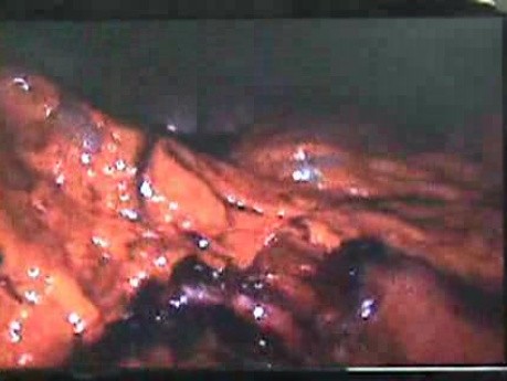 Jejunal Gastrointestinal Stromal tumor (GIST) (47 of 86)