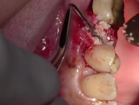 Extraction #13 With Simple Socket Bone Grafting