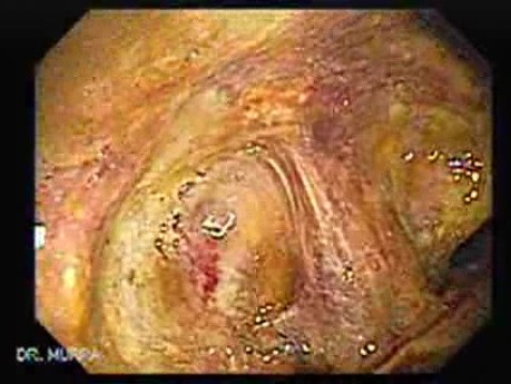 Severe case of Ischemic Colitis (1 of 19)