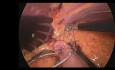 Gastric Electrical Stimulation - Obesity Treatment