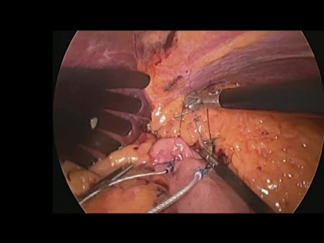 Gastric Electrical Stimulation - Obesity Treatment