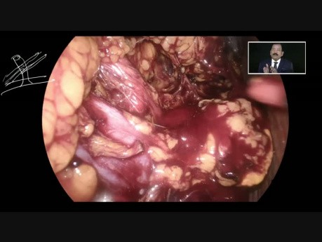 Laparoscopic Nephrectomy