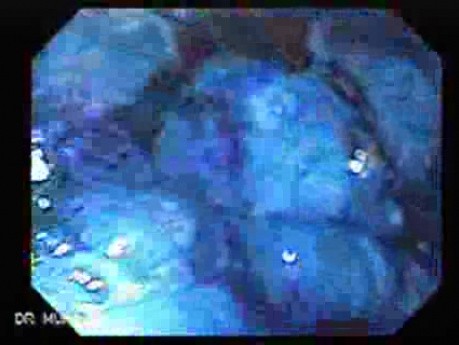 Scirrhous Gastric Carcinoma - Chromoendoscopy (6 of 15)