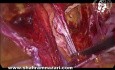 Laparoscopic Repair for Recurrent Inguinal Hernia After Previous Open Approach
