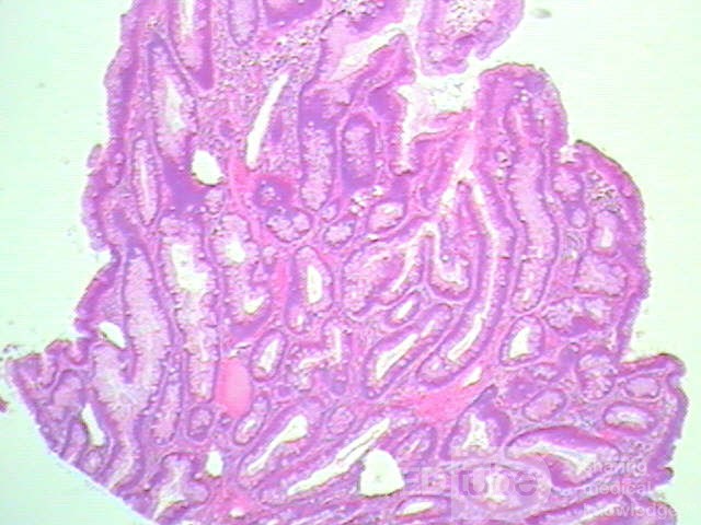 Endoscopic Resection of Giant Tubulo-Villous of the rectum (26 of 35)