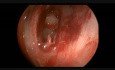 Sphenochoanal Polyp / Supreme Nasal Turbinate / Internal Carotid Pulsation