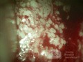 Cervical adenocarcinoma (carcinoma glandulare colli uteri)