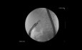 Endoscopic Ultrasound-Guided Choledochoduodenostomy