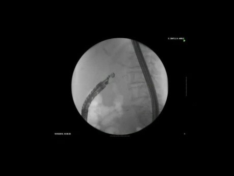Endoscopic Ultrasound-Guided Choledochoduodenostomy