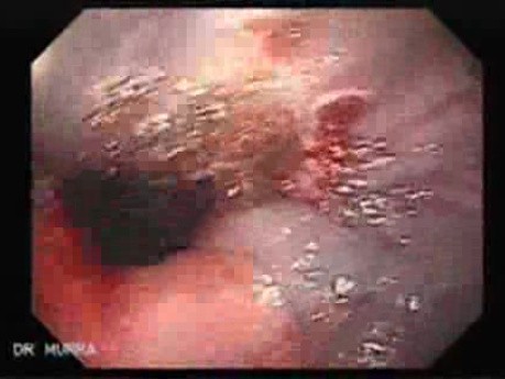 Severe Bleeding of the Upper Digestive System After Two Days of Band Ligation - Coagulation