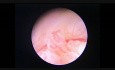 Hyperplasia Complex with Atypias
