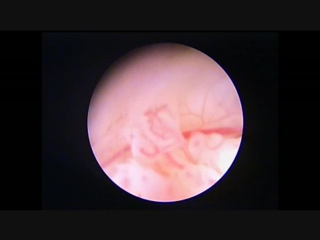 Hyperplasia Complex with Atypias