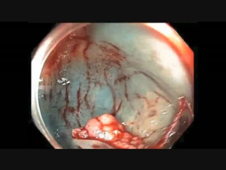 Colonoscopy Channel Quiz 9