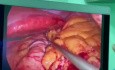 Minilaparoscopic Sleeve