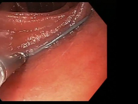 Adverse Event in Bariatric Surgery. Endoscopic Treatment.