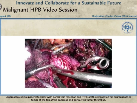 Laparoscopic Distal Pancreatectomy With Portal Vein Resection and PTFE Graft Interposition for Neuroendocrine Tumor of the Tail of the Pancreas and Portal Vein Tumor Thrombus