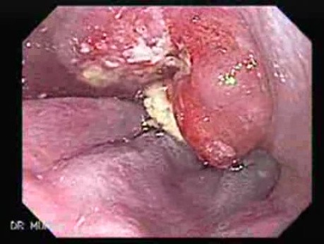 Esophageal Squamous Cell Carcinoma - 72 Years-Old Man