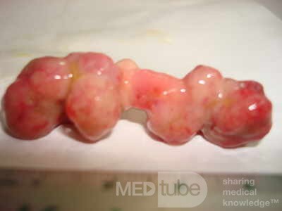 Colonoscopic Polypectomy (23 of 29)