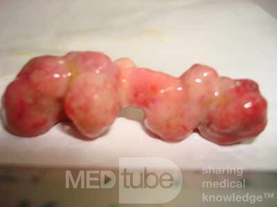 Colonoscopic Polypectomy (23 of 29)