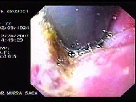 Hemorrhage Due Status Post Rubber Band Ligation of Esophageal Varices - Ulcers and Necrosis After Insertion of Minnesota Tube