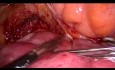 Laparoscopic Resection of Uterus with Fallopian Tubes