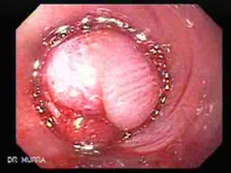 Mucosectomy - Injection to Lift the Lesion, Part 1