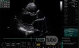 Ostium Secundum Atrial Septal Defect (ASD)