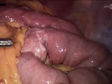 Petersen's Hernia Identification and Correction After Gastric By-pass