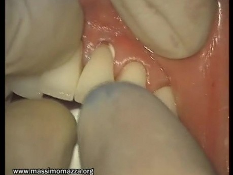 Glass Ionomer Cementation (6/6)