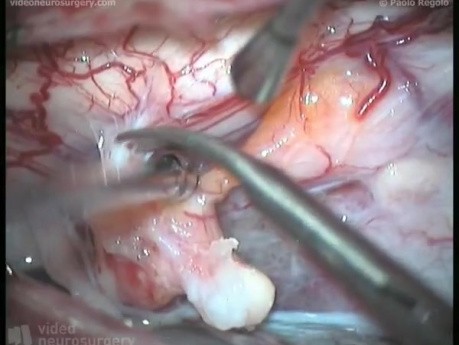 Cervical Intramedullary Teratoma - Posterior Approach