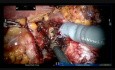 Robotic Multiple Kidney Tumor Enucleation With Selective Vascular Control of Renal Arterial Branches