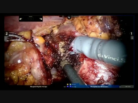 Robotic Multiple Kidney Tumor Enucleation With Selective Vascular Control of Renal Arterial Branches
