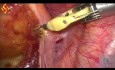 Lap High Anterior Resection and Hepatic Wedge Resection