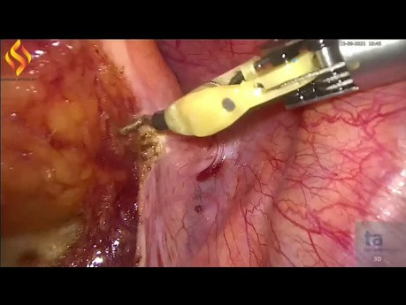 Lap High Anterior Resection and Hepatic Wedge Resection