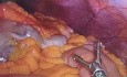 Ultra-low laparoscopic anterior resection