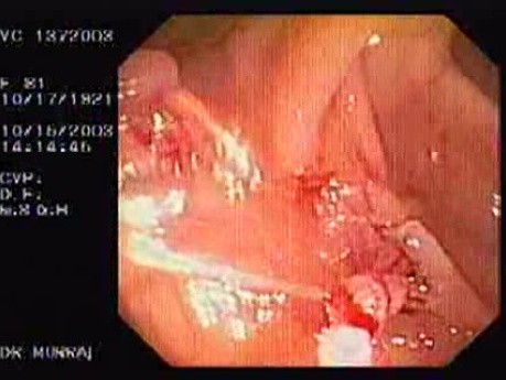 Tubulo - Villous Adenoma - Endoscopy (7 of 28)
