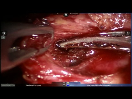 Right Upper Lobe Resection, 81 yo Female