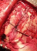 Surgical Planning with Neuronavigator in Patient with Intracranial Mass Lesion. High Grade Glioma.