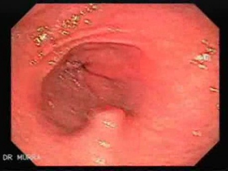 Heterotopic Pancreas and Follicular Lymphoid Hyperplasia (2 of 3)