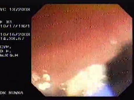 Tubulo - Villous Adenoma - Endoscopy (15 of 28)