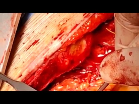 4th Time Redo Operation for Patient with Previous Cabrol Operation