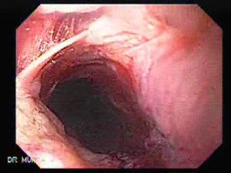 Perforation of a Esophageal Carcinoma After the Procedure with Hydrostatic Balloon Dilation- 62 Year-Old Male